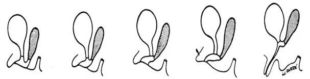 Trastornos del desarrollo sexual - Hermafroditismo (página 2 ...