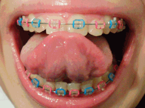 Brackets con ligas de color verdes - Imagui Brackets con ligas de color verdes - Imagui