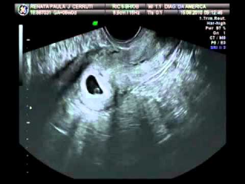 Ultrasom - 5 semanas - YouTube