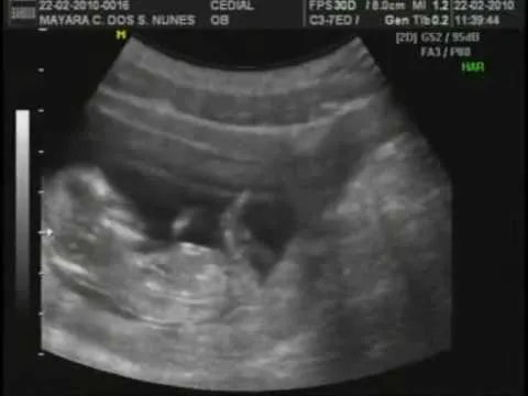 Ultrason 3 meses e 6 dias de gestação - YouTube