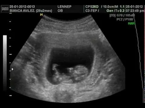 Ultrasonido de 11 semanas / Ultrasound 11 weeks!! - YouTube