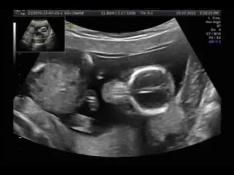 Ultrasonido 14 Semanas Es Niño! - YouTube