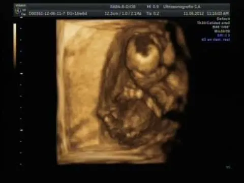 Ultrasonido 17 semanas de embarazo. Es niña! - YouTube Ultrasonido 17 semanas de embarazo. Es niña! - YouTube