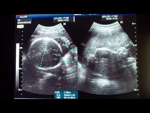 Ultrasonido de jemelos - Imagui