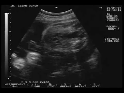 Ultrasonido 32 semanas de embarazo - YouTube