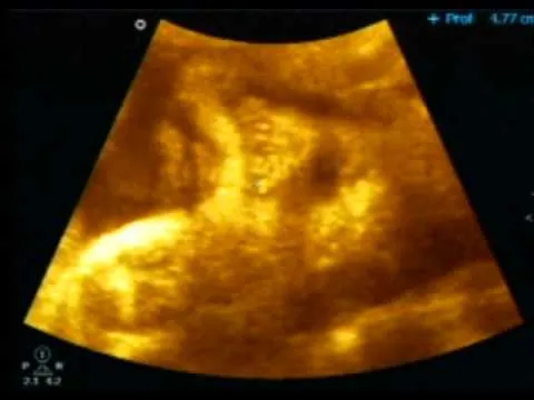 ULTRASONIDO 3D DE MI NENA - YouTube