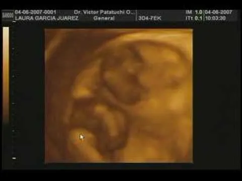 ULTRASONIDO 4D EMB. GEMELAR 8 SEMANAS - YouTube