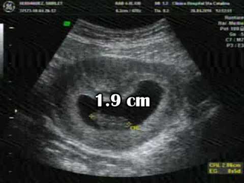 ULTRASONIDO-8 SEMANAS - YouTube