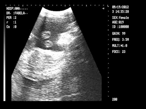 Ultrasonido Anahi 19/09/12 5 Meces - YouTube Ultrasonido Anahi 19/09/12 5 Meces - YouTube
