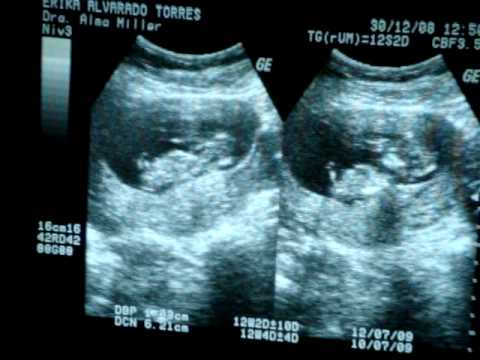 ULTRASONIDO .... BB.. 3 MESES ERI - YouTube ULTRASONIDO .... BB.. 3 MESES ERI - YouTube