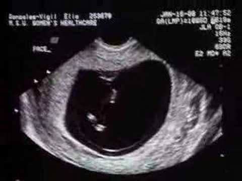 Ultrasonido de bebe a las 10 semanas - YouTube Ultrasonido de bebe a las 10 semanas - YouTube