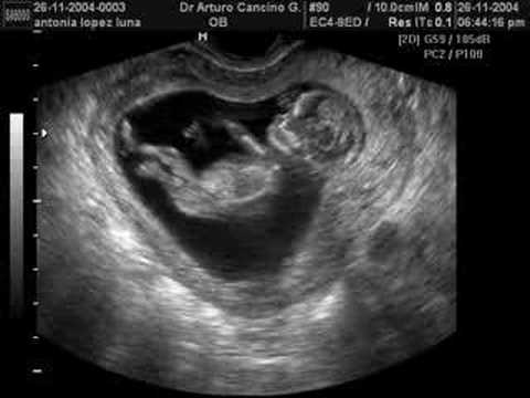 ultrasonido bebe de 13 semanas - YouTube