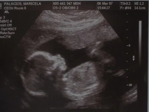 Ultrasonido de bebe Evie | Flickr - Photo Sharing! Ultrasonido de bebe Evie | Flickr - Photo Sharing!