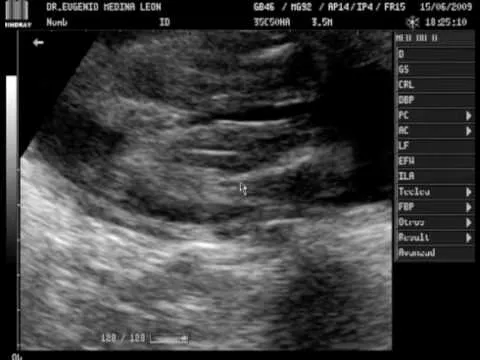 ultrasonido bebe 5 meses barbera rosas - YouTube ultrasonido bebe 5 meses barbera rosas - YouTube