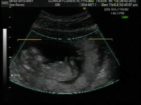 ultrasonido 3 meses (12 semanas)