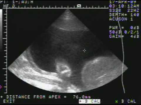 ULTRASONIDO BEBE 6 MESES - YouTube