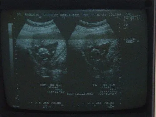 Ultrasonido | Angel Daniel's Blog