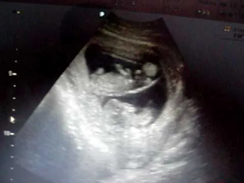ultrasonido cuates tres meses aline 1 - YouTube ultrasonido cuates tres meses aline 1 - YouTube