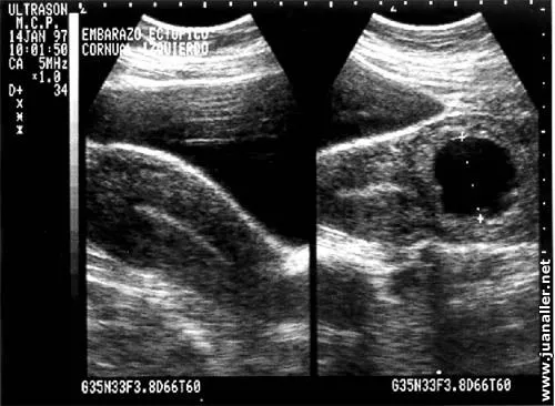 Ultrasonido del embarazo
