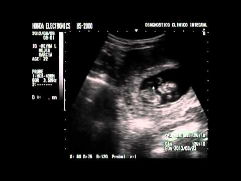ULTRASONIDO EN EMBARAZO DE 3 MESES DR. POLANCO - YouTube ULTRASONIDO EN EMBARAZO DE 3 MESES DR. POLANCO - YouTube