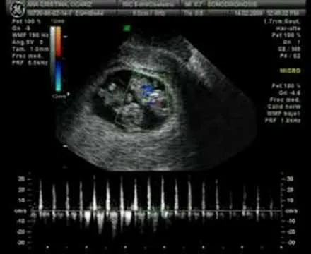 Ultrasonido de gemelos 2 meses - Imagui