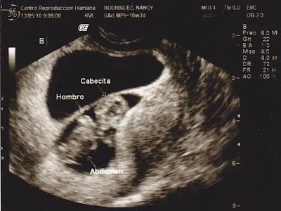 Ultrasonido de gemelos de 2 meses - Imagui