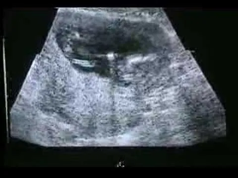 Ultrasonido de mi hijo a los 3 meses de embarazo - YouTube Ultrasonido de mi hijo a los 3 meses de embarazo - YouTube
