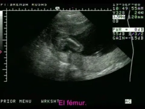 Ultrasonido de Mariana a las 17 semanas - YouTube Ultrasonido de Mariana a las 17 semanas - YouTube