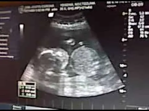 Ultrasonido Mellizos Granillo Moctezuma No. 3 - YouTube Ultrasonido Mellizos Granillo Moctezuma No. 3 - YouTube