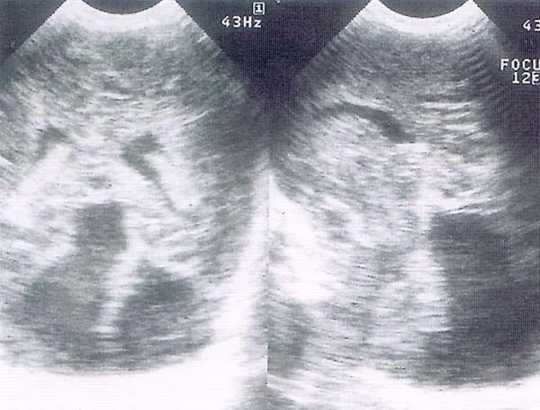 MALFORMACIONES CEREBRALES CONGÉNITAS VALORADAS POR ULTRASONIDO ...