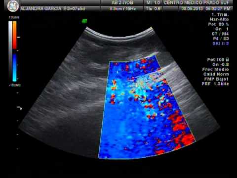 Ultrasonido 1 mes - YouTube