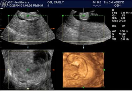 Ultrasonido de 3 meses en 3D - Imagui
