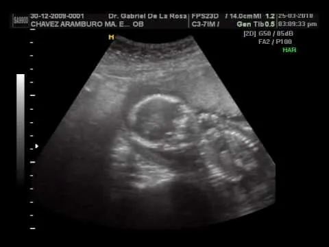Ultrasonido 1 mes de embarazo - Imagui