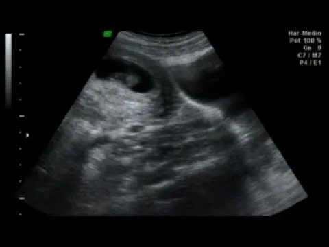 Ultrasonido de 2 meses de embarazo - Imagui