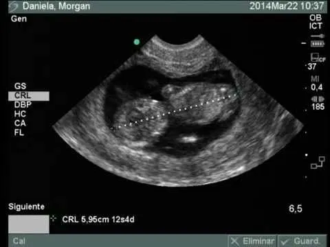 Ultrasonido de 3 meses de embarazo. - YouTube Ultrasonido de 3 meses de embarazo. - YouTube
