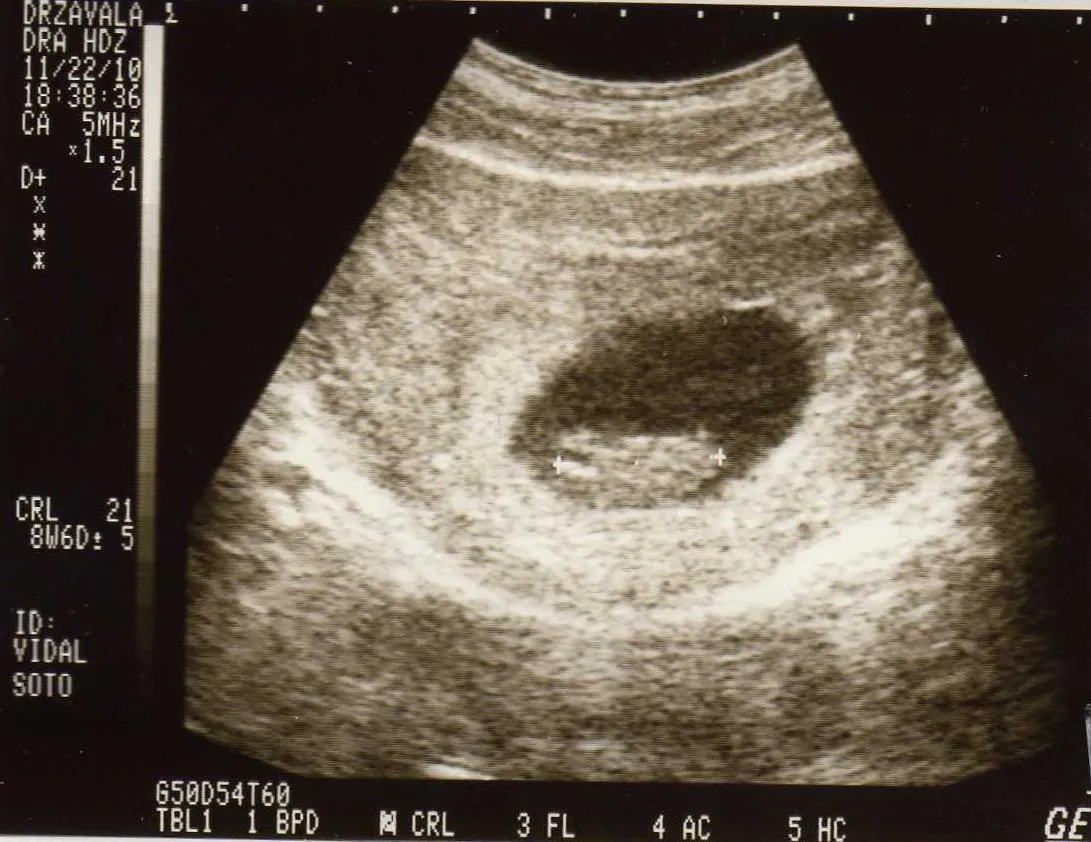 Ultrasonido de 3 meses - Imagui