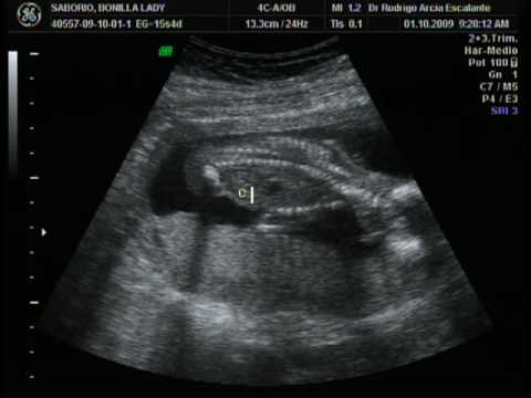ultrasonido de 4 meses. Rojas Saborio - YouTube