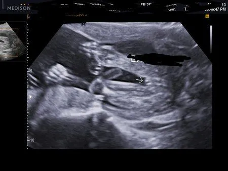 Ultrasonido de niña de 5 meses - Imagui