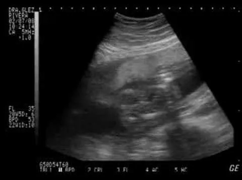 ultrasonido de la niña mendoza gutierrez febrero 2008 - YouTube