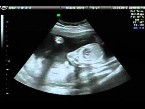 ULTRASONIDO OBSTETRICO - YouTube