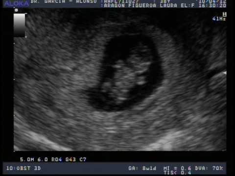 Ultrasonido 8 semanas de embarazo - Imagui