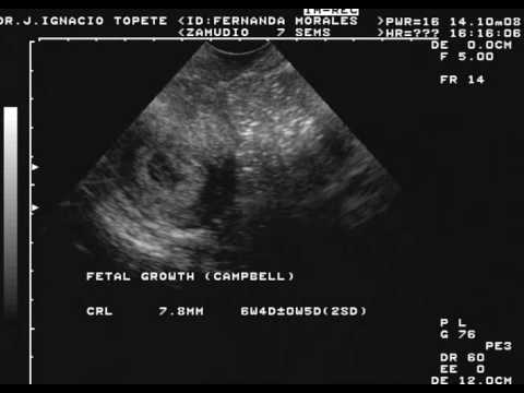Ultrasonido 7 Semanas - YouTube