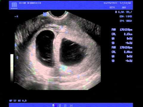 Ultrasonido trillizos Rossy 29032011 - YouTube Ultrasonido trillizos Rossy 29032011 - YouTube