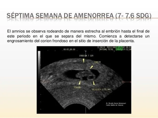 ultrasonido del primer trimestre