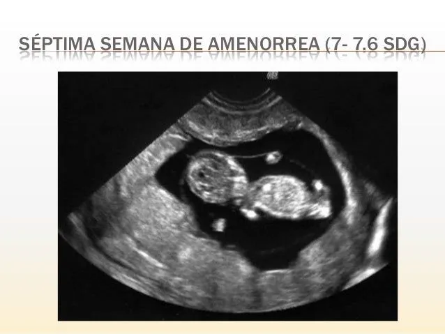 ultrasonido del primer trimestre