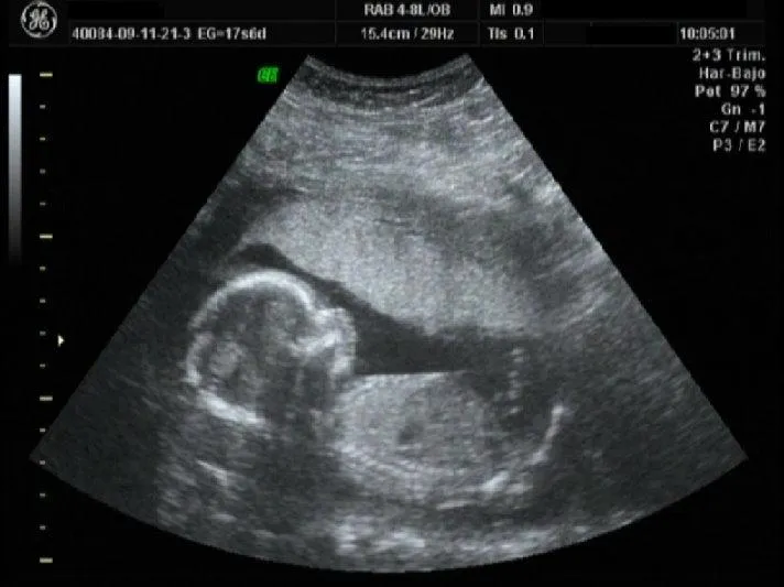 Ultrasonidos de bebés imagenes - Imagui