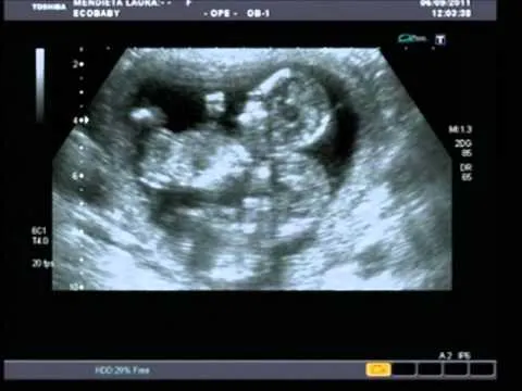 Ultrasonido gemelos de 3 meses - Imagui