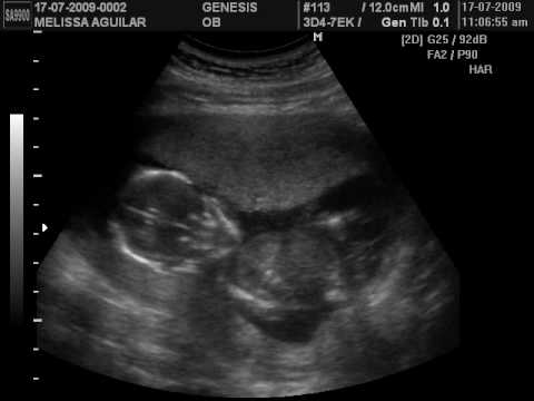 Ultrasonido a los 6 meses - Imagui