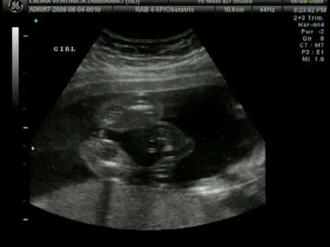 Ultrasonidos de niñas - Imagui