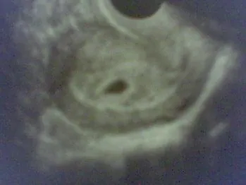 Mi Vida Con Julieta: Primera Ecografía de Gestación Mi Vida Con Julieta: Primera Ecografía de Gestación